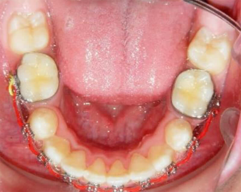 Fig. 6 Vista oclusal corrección del apiñamiento superior e inferior.