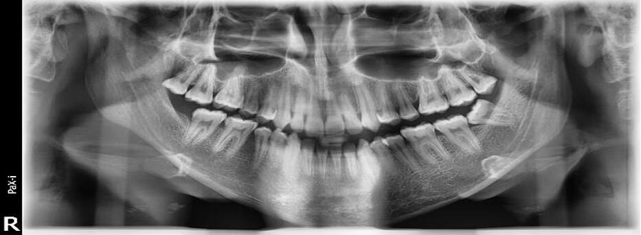 Fig. 10 Radiografía panorámica