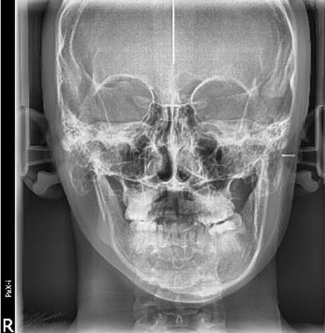 Fig. 11 Radiografía postero anterior