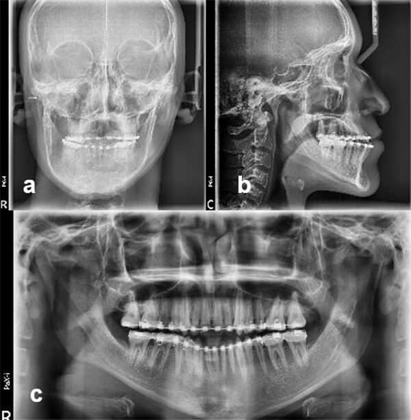 Fig.15: a. radiografía postero anterior; b. rx lateral de cráneo; c. radiografía panorámica de progreso.
