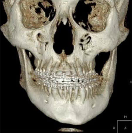 Fig. 16 reconstrucción 3D de la tomografía axial computarizada de haz de cono de frente.