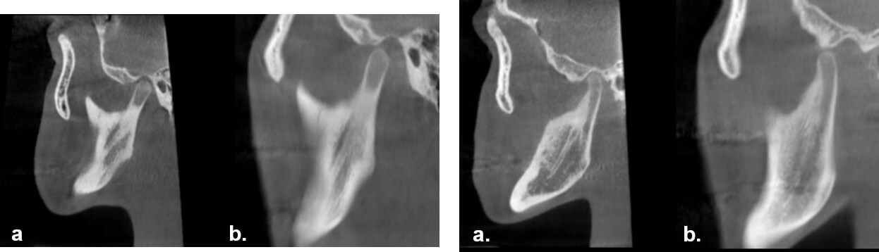 Fig.17  Comparación boca abierta y cerrada