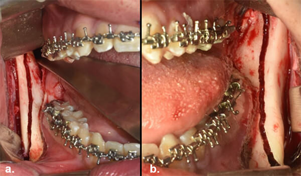 Fig. 19 derecha(a) e izquierda (b)