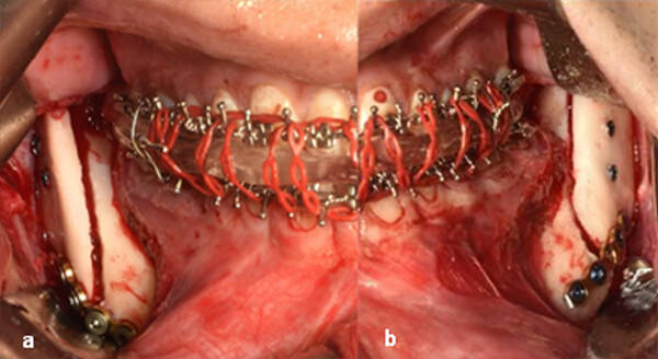 Fig. 20 fijación rígida de la rama mandibular: derecha(a) e izquierda (b)