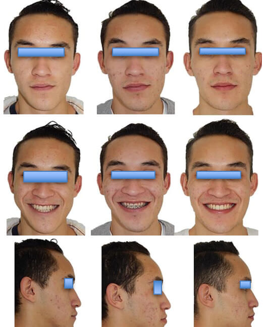 Fig. 24 comparación de inicio, progreso y final en fotografías extraorales de frente (fila superior); frente sonrisa (fila intermedia) y extraorales de perfil (fila inferior).