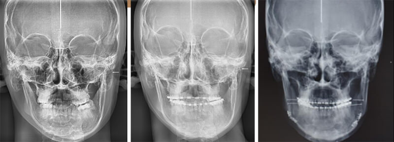 Fig. 25 comparación inicio, preoperatorio y postoperatorio de rx. postero anteriores