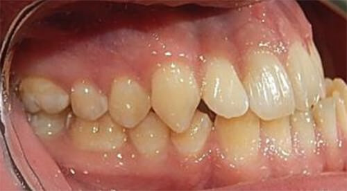 Fig. 5 intraoral lateral derecha