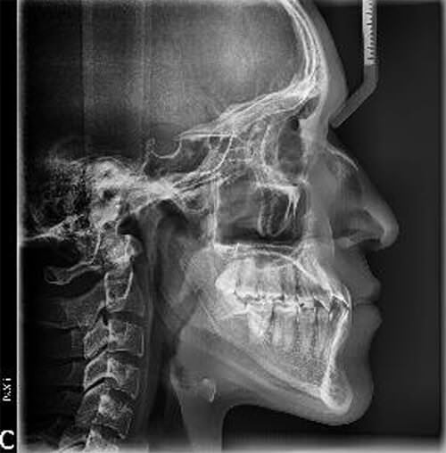 Fig. 9 Radiografía lateral de cráneo