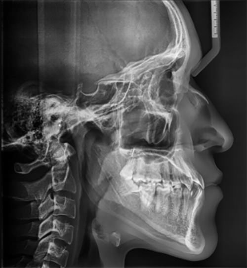 Fig. 1 radiografía lateral de cráneo