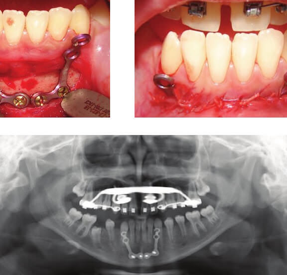 tornado Persuasivo tubo Protracción maxilar con mini-placas en pacientes Clase III en crecimiento