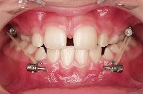 Máscara facial: A) modelo de Delaire y cols(2), B) modificación de Petit(3)