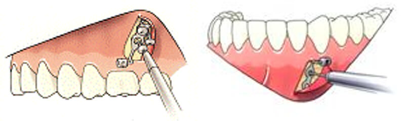 Máscara facial: A) modelo de Delaire y cols(2), B) modificación de Petit(3)