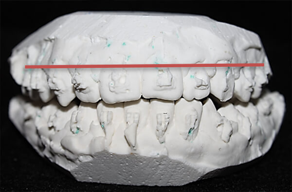 Figura 7. Ancho transversal del maxilar Resultados 57mm 