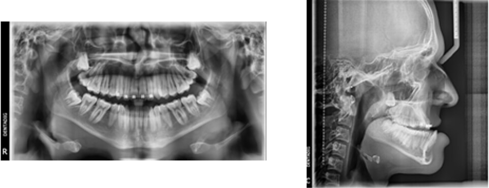 Figura 3.Radiografía panorámica y lateral de cráneo