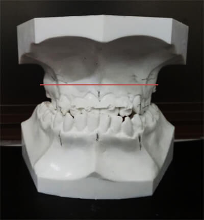 Figura 4. Ancho transversal del maxilar Inicio del tratamiento 55mm