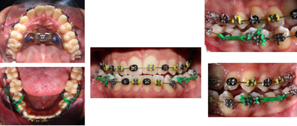 Figura 5. Fotografías de progreso en el tratamiento a los 5 meses de control Oclusal superior e inferior, frontal y lateralidad derecha e izquierda
