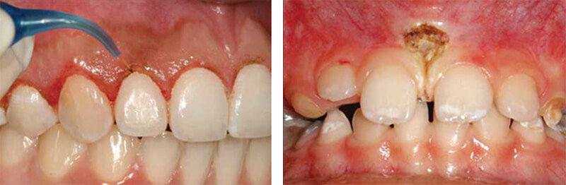 Aplicación del láser para la gingivectomía / Frenectomía con láser