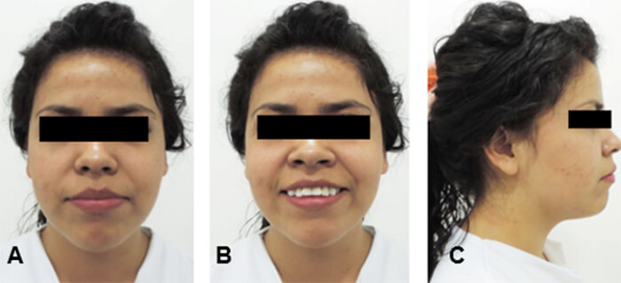 Figura 1: Fotografías extraorales: frontal (A) sonrisa (B) y lateral (C).