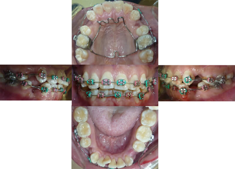 Figura 9: Extracción de premolares superiores e inferiores y colocación de brackets MBT inferiores.