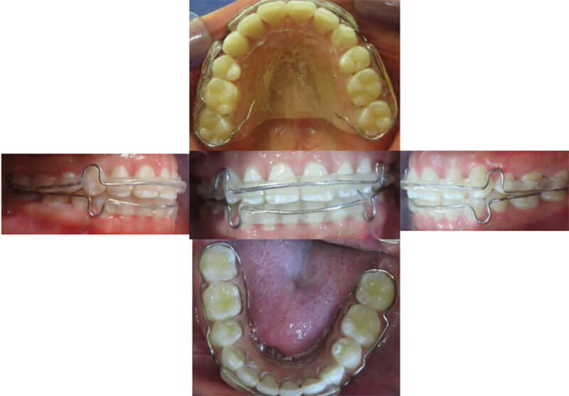 Figura 9: Extracción de premolares superiores e inferiores y colocación de brackets MBT inferiores.