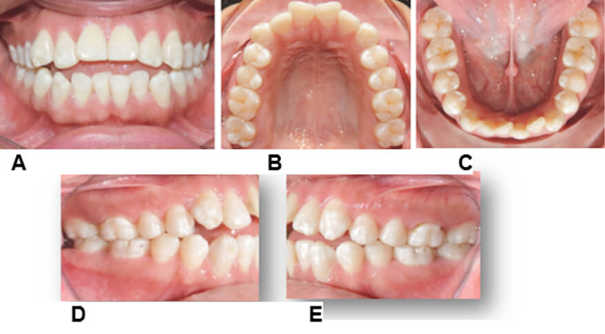 Figura 2: Fotografías intraorales iniciales: frontal (A), oclusal superior (B), oclusal inferior (C), lateral derecha (D), lateral izquierda (E).