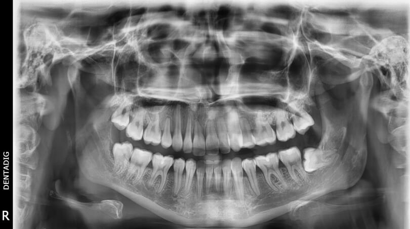 Figura 11. Radiografía panorámica