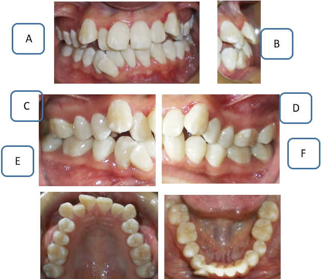 Figura 2. Fotos Intraorales A. Frontal. B sobresalte. C. Lateral derecha. D lateral izquierda. E.  oclusal superior. F. oclusal inferior