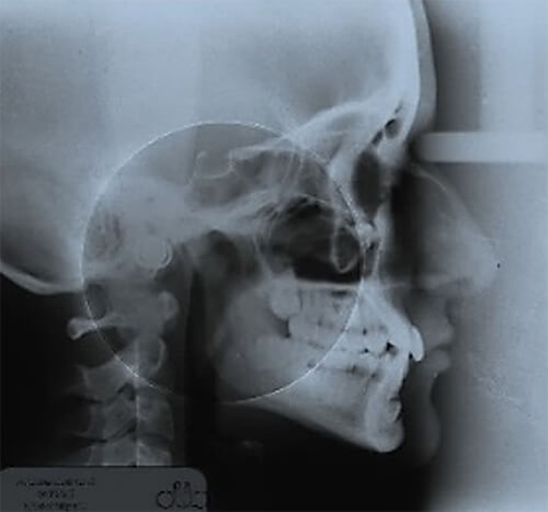 Figura 4. Foto radiografía lateral de cráneo