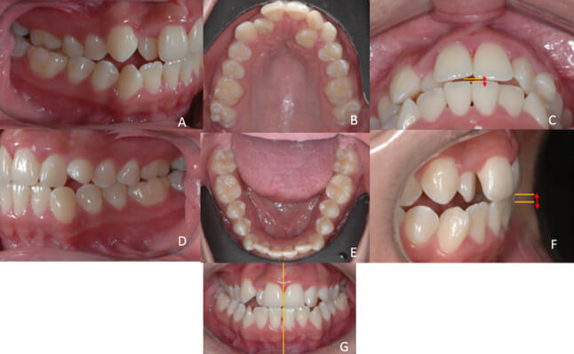 Figura 2. Fotografías intraorales iniciales. A .Lateral derecha, B. Oclusal superior C. Resalte D. Lateral izquierda E. Oclusal inferior F. Sobremordida G. Frontal