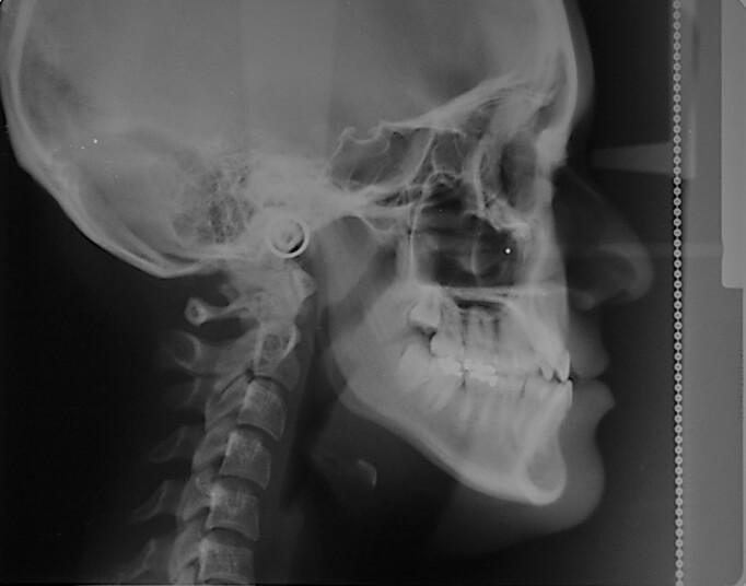 Figura 4. Radiografía de perfil.