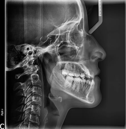 Fig. 1 Radiografía lateral de cráneo