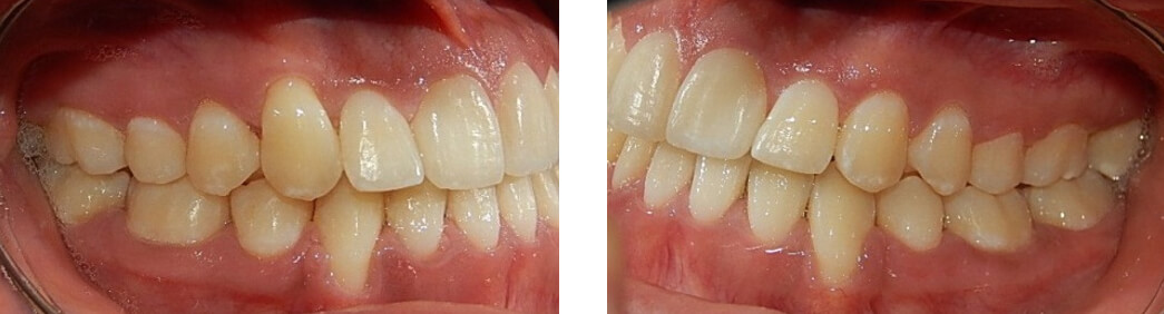 Fig. 10 Lateral derecha e izquierda