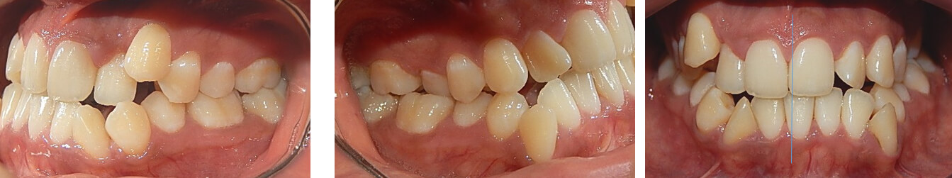 Fig. 3 Intraoral derecha, izquierda, frente