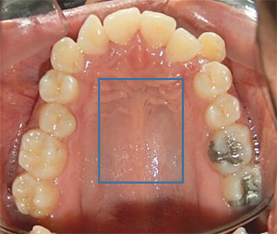 Fig. 4 Oclusal superior