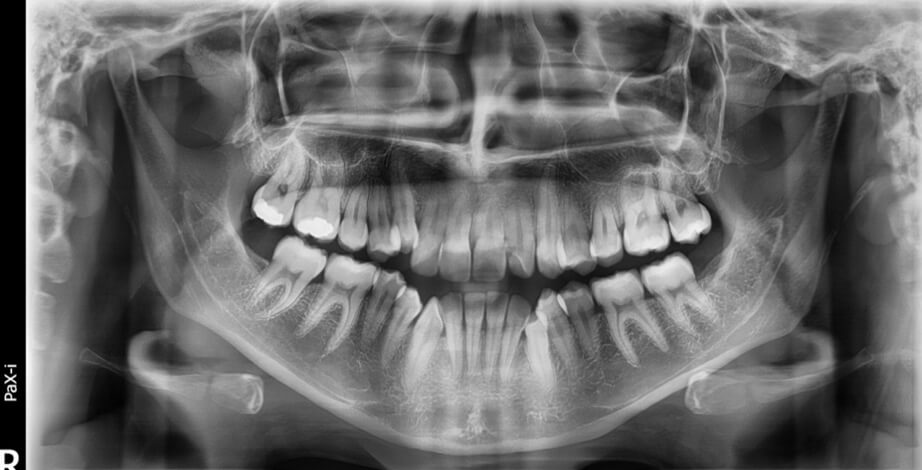 Fig. 6 Radiografía panorámica.