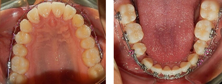 Fig. 8 Oclusal superior e inferior