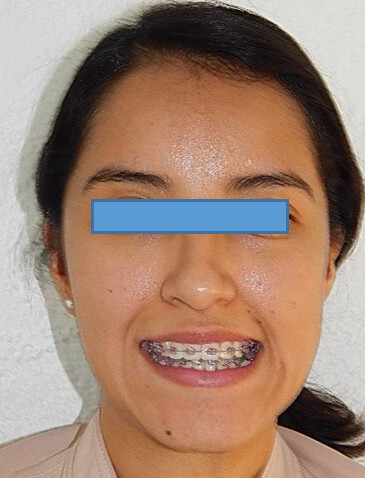 Fig. 9 Sonrisa