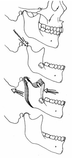 Fig 1. Ilutracion de Desplazamiento por depósito y reabsorción (Enlow y Hans 1992)