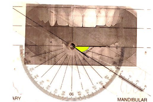 Figura 5B Medición del AFMP izquierdo