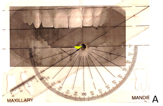 Figura 5A. Medición del AFMP derecho