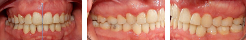 Fig.11 intraoral frente y laterales derecha e izquierda