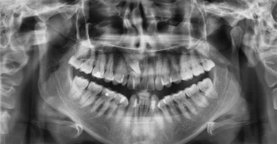 Fig.5 Radiografía panorámica