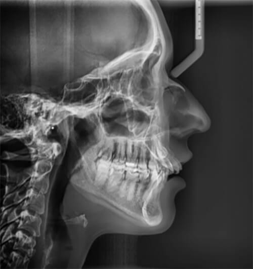 Fig.6 Radiografía lateral de cráneo