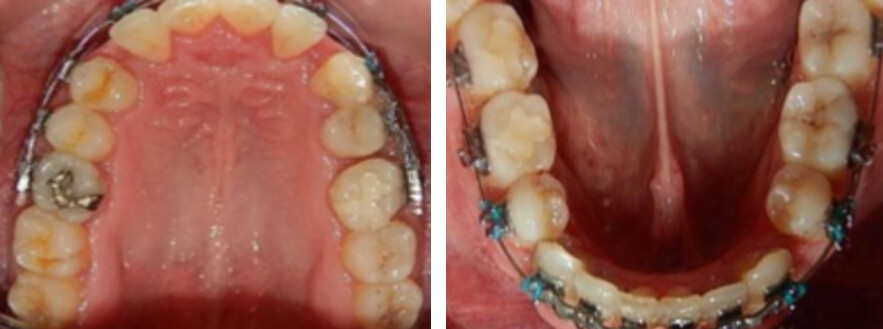 Fig.7 intraoral oclusales