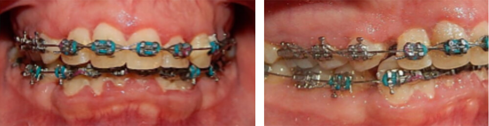 Fig. 8 intraoral de frente y derecha