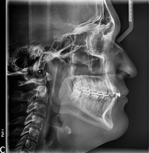 Fig. 1 Radiografía lateral de cráneo