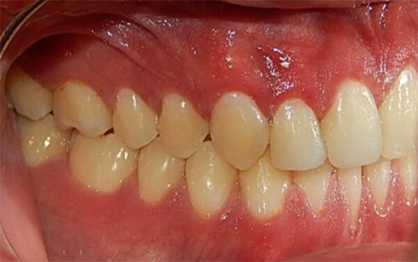 Fig.14 Intraoral derecha