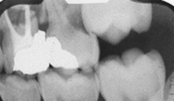 Imagen 1: Radiografía bitewing lado izquierdo