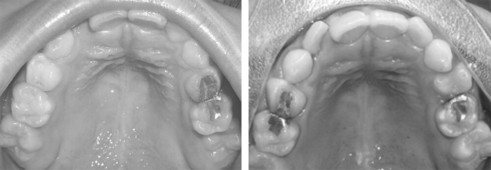 Imagen 3: Comparación entre el inicio del tratamiento (fotografía izquierda) y el final del tratamiento (fotografía derecha)
