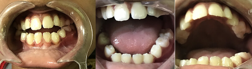 Figura #1: vista intraoral. Se observa la ausencia clínica de incisivos centrales Inferiores y bicúspides. Además de la presencia de varios dientes temporales a los 12 años (cuando deciden retomar el tratamiento).